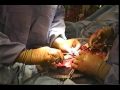Taken in about 1995, I gave my surgeon my video camera and somehow convinced him to video tape my operation. The operation was to remove several diseased sections of colon/small bowel effected by my Crohn's Disease. This was actually the 2nd time my surgeon had opened me up like this and pulled a whole bunch of pieces out. I got to hold almost the entire length of my large intestines in my hands (after the surgery was complete of course). I guess I'm a tinkerer to the end, even when it concerns my own body mechanics. I love to know how stuff works. There's one shot I particularly like where you can hear the heart monitor beeping and you can see the intestines giggle subtlety with each beep. And I absolutely adore how they are explaining each step to ME in the first-person as the video proceeds while I'm laying there dead(ish) on the table. LOL.