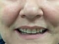 cosmetic dental veneer procedure from The Gentle Dentist cosmetic dental veneer procedure from The Gentle Dentist