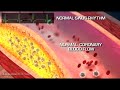 HOW A FATAL HEART ATTACK HAPPENS - TIM RUSSERT  Heart Attack Coronary Thrombosis