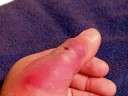 brown recluse spider bite brown recluse spider bite
