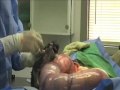 Mastiff - English Mastiff C-Section - dog cesarean surgery Mastiff - English Mastiff C-Section - dog cesarean surgery