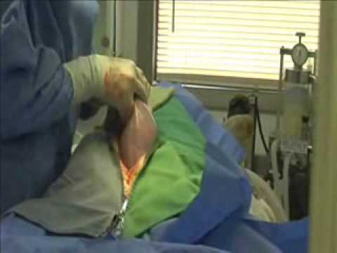 how to treat hematoma after c section