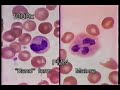Basic Medical Pathology - Acute Inflammation II