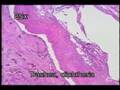 Basic Medical Pathology - Acute Inflammation II