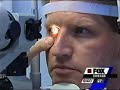 Living with Lasik - 1 Living with Lasik - 1