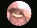 Nasal Endoscopy