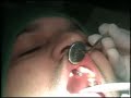 Implante KOPP  Sistema Friccional - Unitario Anterior