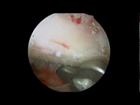 AC separation repair - DogBone