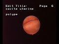 hysteroscopic aspect of endometrial polyps hysteroscopic aspect of endometrial polyps