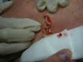 Pus Cyst on Back Popped Squeezed Exploded - Edit