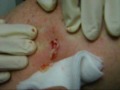 Pus Cyst on Back Popped Squeezed Exploded - Edit