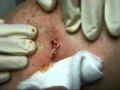 Pus Cyst on Back Popped Squeezed Exploded - Edit