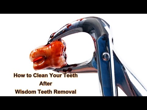 video-linktoworks-How To Clean Your Teeth After Wisdom Teeth Removal