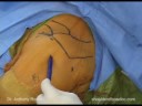 From Open to Arthroscopic Rotator Cuff Repair with Anthony A. Romeo, M.D., Part 1 From Open to Arthroscopic Rotator Cuff Repair with Anthony A. Romeo, M.D., Part 1