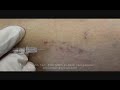 sclerotherapy sclerotherapy