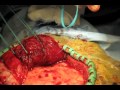 Temporal Craniotomy HD