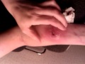 underarm infection 2