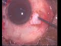 Primary Vitrectomy + Retinal Detachment Virectomy + Membrane Peel + Silicone Oil + Cryo_Part1.flv
