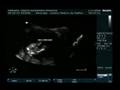 Ultra-Sonografia Obstétrica Translucência Nucal-1°Trimestre