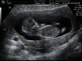 12 week ultrasound scan 12 week ultrasound scan