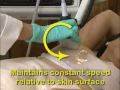 sonocine,breast cancer,mammography