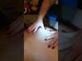 popping a cyst