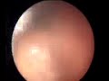 Greenlight PVP - Photoselective Vaporization of the Prostate