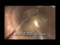 New era of Cataract Surgery