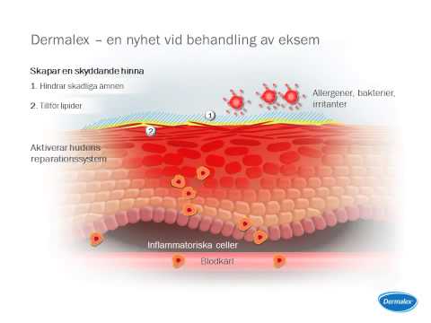 how to treat ekseem