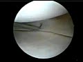 Reparaci�n Sutura meniscal - Meniscus Suture