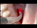 Laser Apicoectomy - Lares PowerLase® All-Tissue Laser