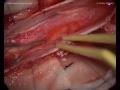 Thoracic meningioma - Posterior approach