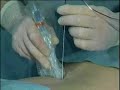 Psoas Block (sample) - www.proceduresconsult.com