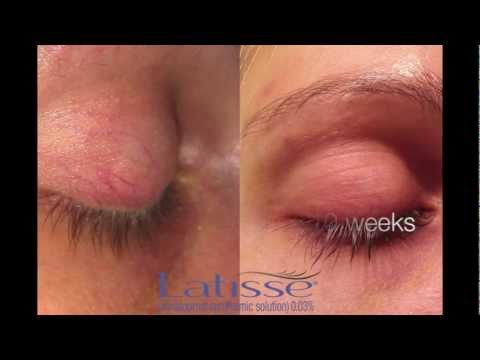 lastisse columbus - Latisse is one of the best products know to woman when it comes to longer lashes. Please enjoy the time lapsed the results of Latisse over 10 week period. Ca...