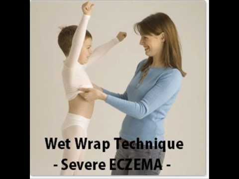 how to wet wrap eczema