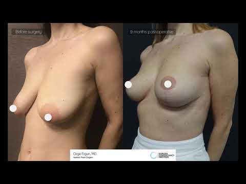 Breast Lift Before After - 9 Months Result | Ozge Ergun MD | Plastic Surgery