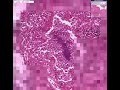 Histopathology Lung--Abscess, bronchopneumonia Histopathology Lung--Abscess, bronchopneumonia