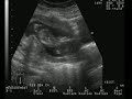 Ultrasonido de 13 semanas y media.