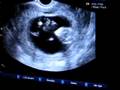 videos de Our Baby's First Ultrasound!!!