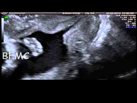 how to measure afi ultrasound