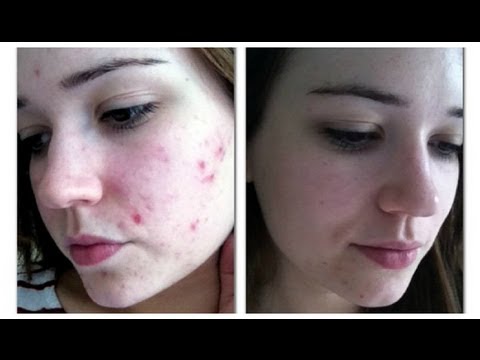 Skin Care Routine Before and After