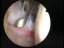 Bankart lesion after shoulder manipulation Frozen shoulder Bankart lesion after shoulder manipulation Frozen shoulder