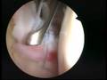 Bankart lesion after shoulder manipulation Frozen shoulder