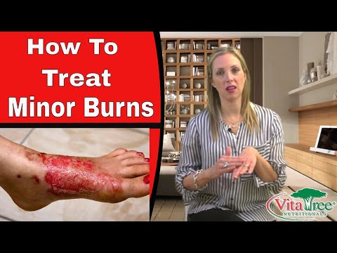 how to cure minor burns