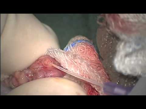 how to collect sperm for ivf