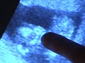 Cashew - 13 Week Ultrasound - December 8, 2006