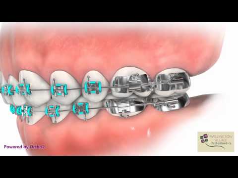 how to apply wax to braces