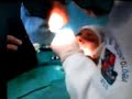 Cirurgia de resto radicular próximo ao seio maxilar- PARTE 1 Cirurgia de resto radicular próximo ao seio maxilar- PARTE 1