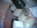 Veneer Removal with VersaWave Erbium Laser Veneer Removal with VersaWave Erbium Laser