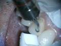 Veneer Removal with VersaWave Erbium Laser